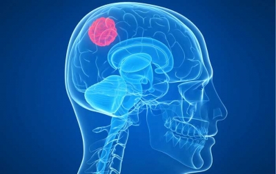 روش‌های نوین درمان تومورهای مغزی