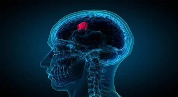 تومور مغزی مننژیوم
